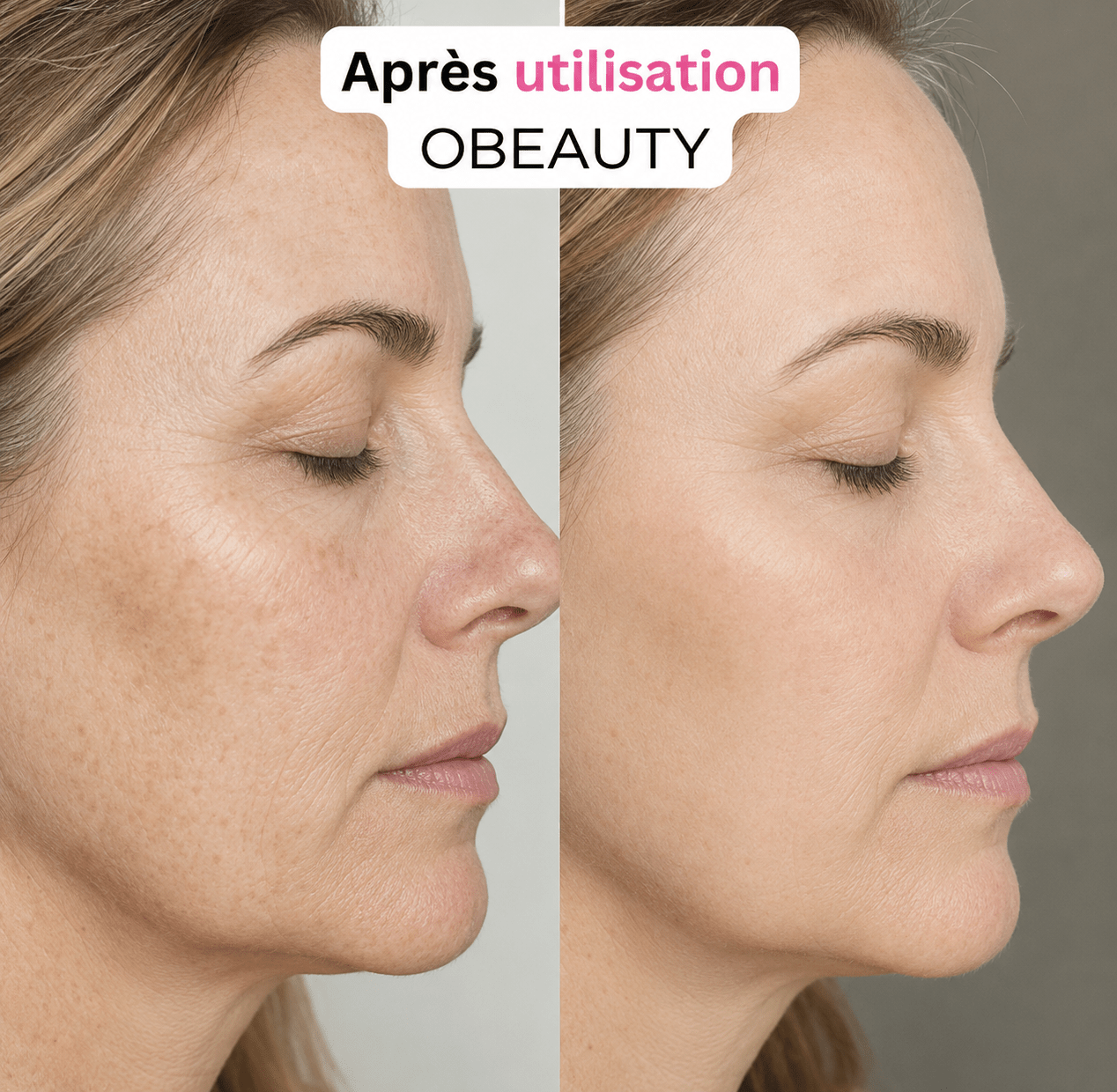 Système de Micro - Infusion OBEAUTY - OBEAUTY